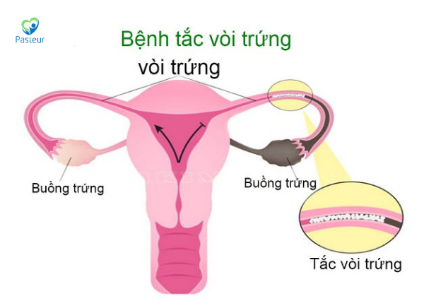 TẮC VÒI TRỨNG CÓ KINH NGUYỆT KHÔNG Ảnh minh họa