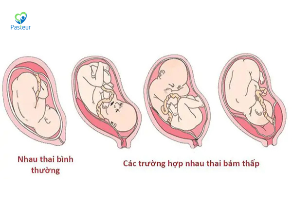 NHAU BÁM THẤP VÀ CÁCH THEO DÕI THAI KỲ AN TOÀN 1 NHAU BÁM THẤP VÀ CÁCH THEO DÕI THAI KỲ AN TOÀN Ảnh minh họa