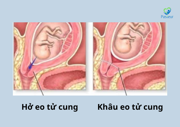 HỞ EO TỬ CUNG ĐIỀU TRỊ NHƯ THẾ NÀO Ảnh minh họa