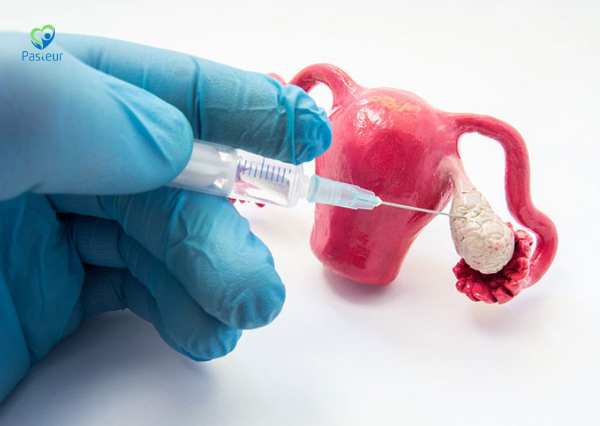 hội chứng quá kích buồng trứng