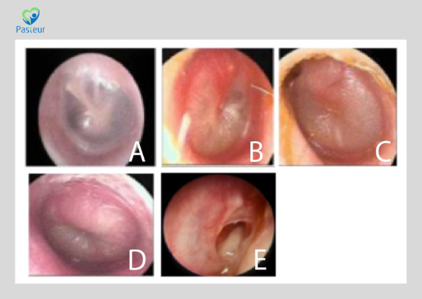 VIÊM TAI GIỮA Ở TRẺ EM Ảnh minh họa