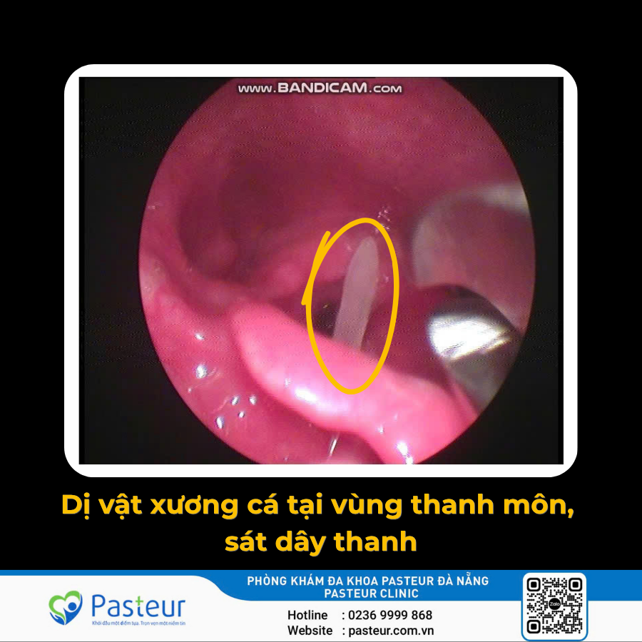 GẮP DỊ VẬT XƯƠNG CÁ TẠI VÙNG THANH MÔN, SÁT DÂY THANH 1 GẮP DỊ VẬT XƯƠNG CÁ TẠI VÙNG THANH MÔN, SÁT DÂY THANH Ảnh minh họa
