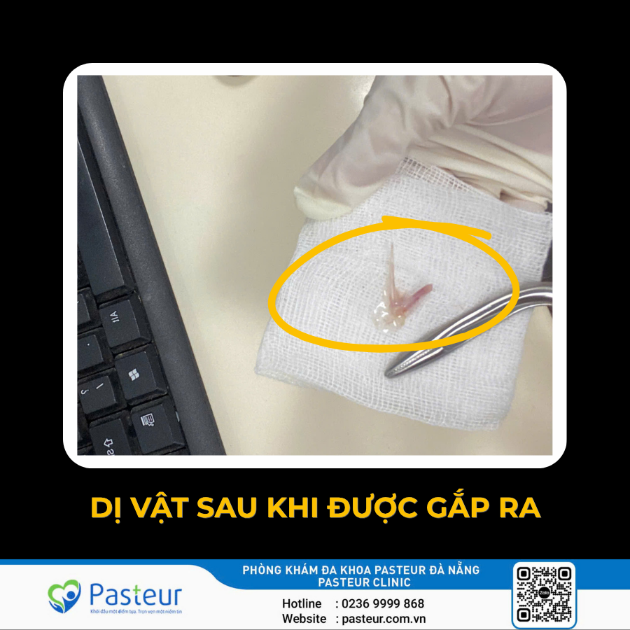 GẮP DỊ VẬT XƯƠNG CÁ TẠI VÙNG THANH MÔN, SÁT DÂY THANH 2 Gắp xương cá