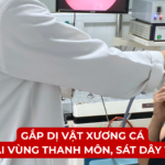 GẮP DỊ VẬT XƯƠNG CÁ TẠI VÙNG THANH MÔN, SÁT DÂY THANH Ảnh minh họa