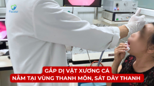 GẮP DỊ VẬT XƯƠNG CÁ TẠI VÙNG THANH MÔN, SÁT DÂY THANH 12 GẮP DỊ VẬT XƯƠNG CÁ TẠI VÙNG THANH MÔN, SÁT DÂY THANH Ảnh minh họa